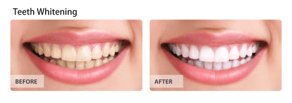 Before and After image of Teeth-whitening