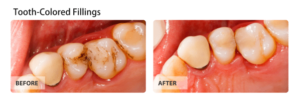 Before and After image of Tooth-Colored-Fillings