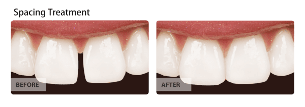 Before and after image of spacing-treatment